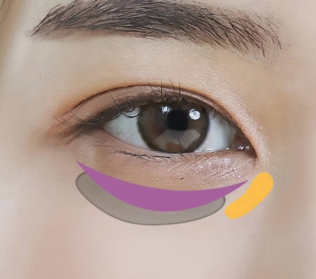 Lower Blepharoplasty