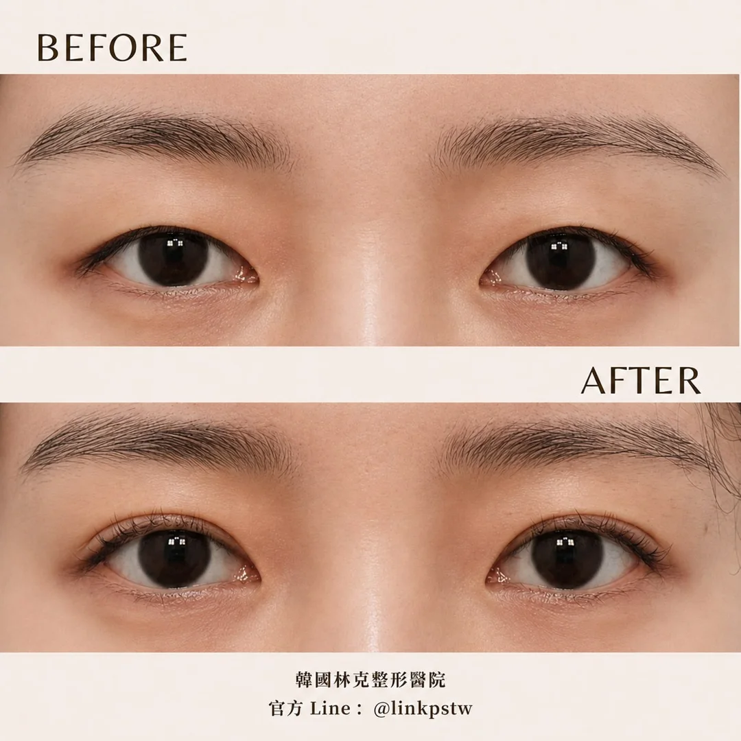 雙眼皮術後真實案例 — 林克整形醫院 術前術後案例