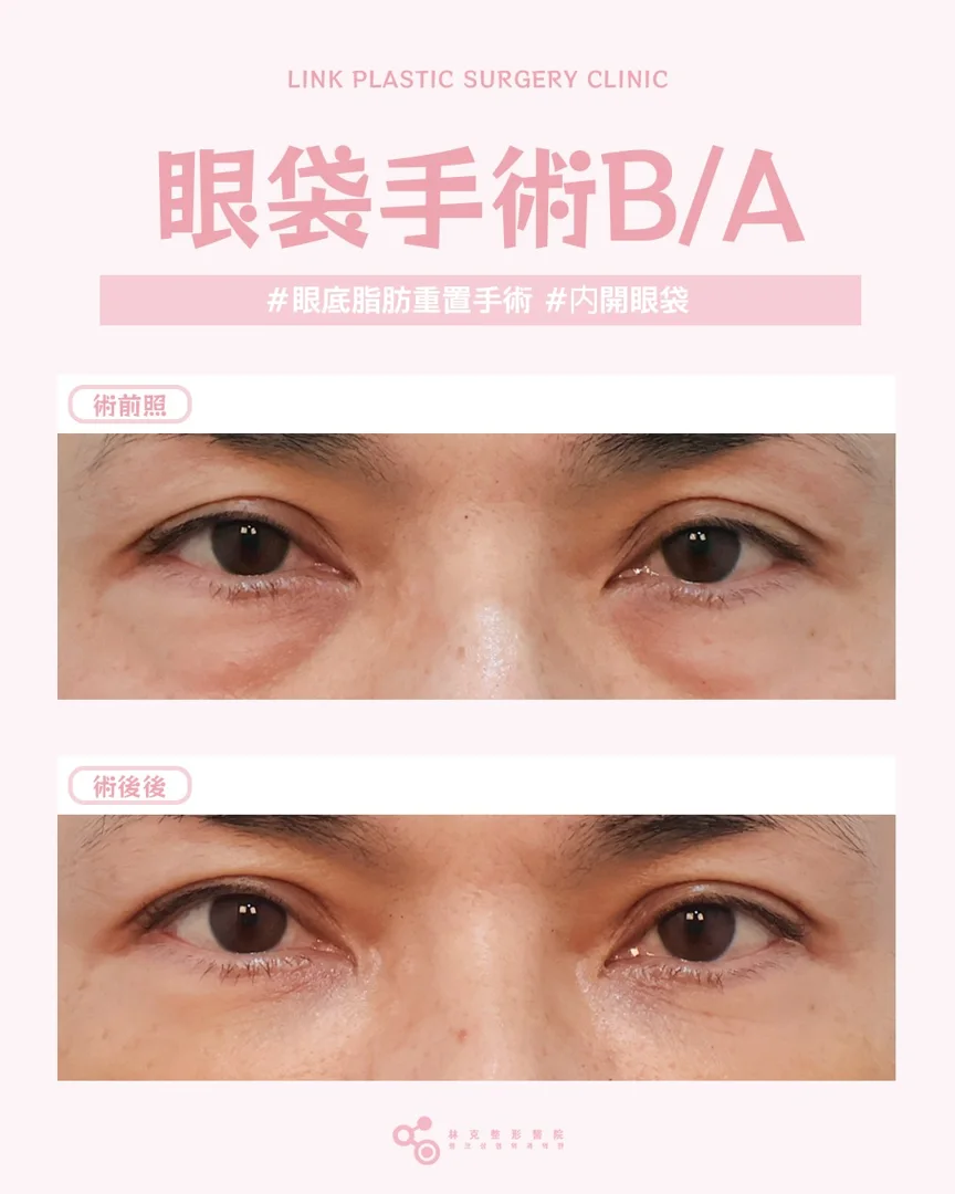眼袋術後真實案例 — 林克整形醫院 術前術後案例