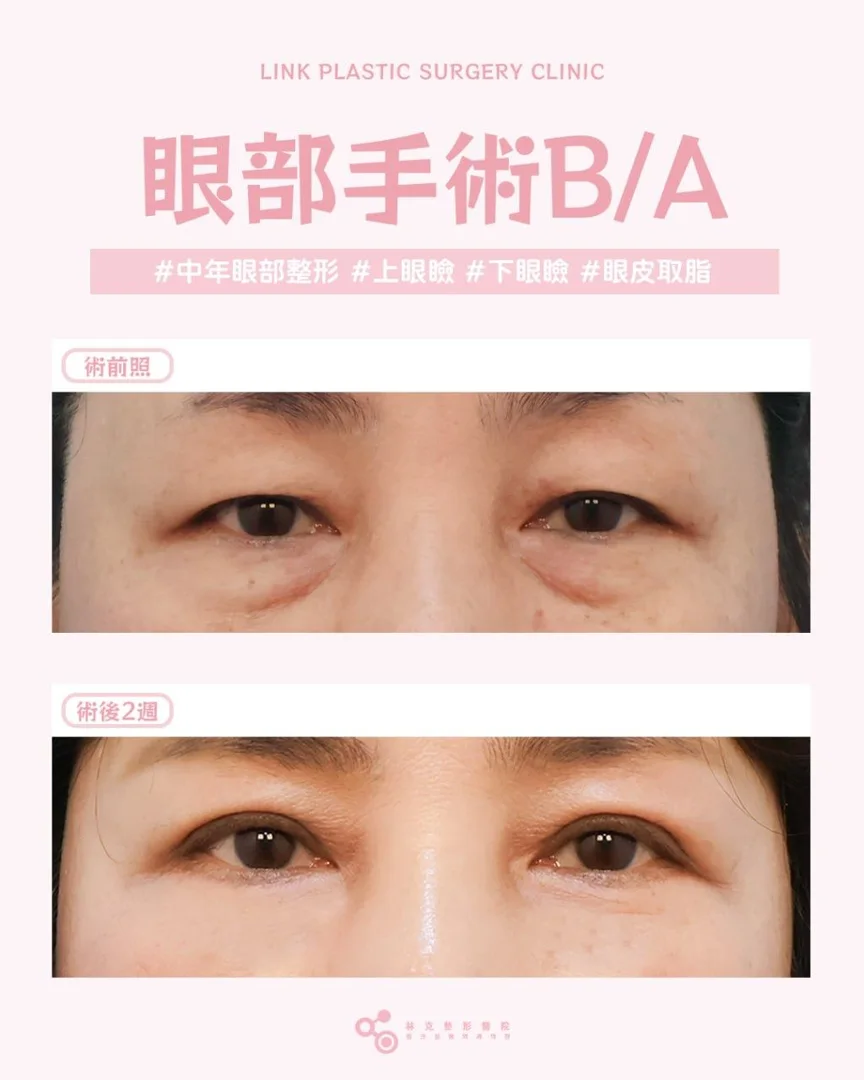上下眼瞼手術真實案例 — 林克整形醫院 術前術後案例