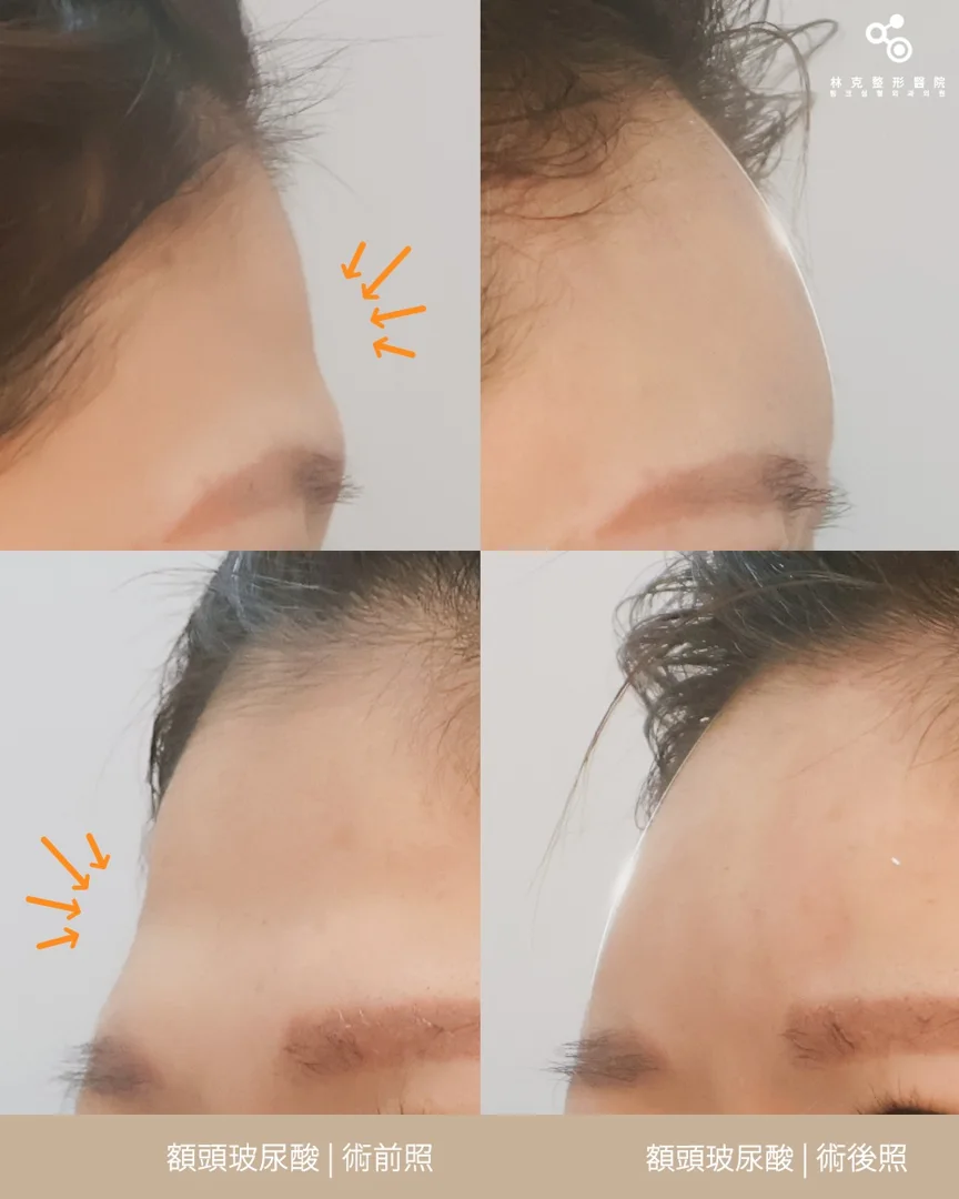 額頭玻尿酸 術前術後 — 林克整形醫院 術前術後案例