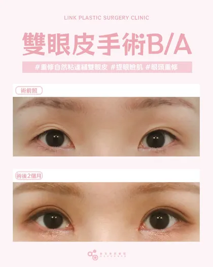 林克整形醫院 | 雙眼皮術後真實案例分享 ✨🧡手術項目: 重修自然粘連縫雙眼皮+提眼瞼肌+眼頭重修🧡