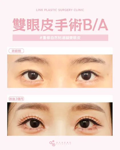 林克整形醫院 | 雙眼皮術後真實案例分享 ✨🧡手術項目: 重修自然粘連縫雙眼皮🧡每雙眼睛都有最適合的