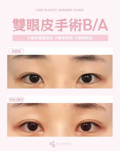 林克整形醫院 | 雙眼皮術後真實案例分享 ✨🧡手術項目: 重修縫雙眼皮+重修眼頭+提眼瞼肌🧡修補以前