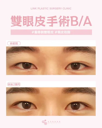 林克整形醫院 | 雙眼皮術後真實案例分享 ✨🤎手術項目: 重修割雙眼皮+眼皮取脂🤎男生的雙眼皮重修，