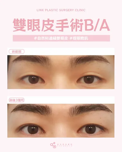 林克整形醫院 | 雙眼皮術後真實案例分享 ✨🤎手術項目: 自然粘連縫雙眼皮+提眼瞼肌🤎男生的眼神重點