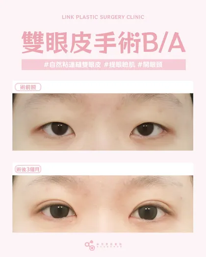 林克整形醫院 | 雙眼皮術後真實案例分享 ✨💙手術項目: 縫雙眼皮+提眼瞼肌+開眼頭💙想要自然不做作