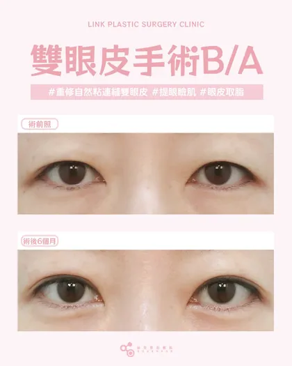 林克整形醫院 | 雙眼皮術後真實案例分享 ✨🧡手術項目: 重修縫雙眼皮+提眼瞼肌+眼皮取脂🧡線條過高