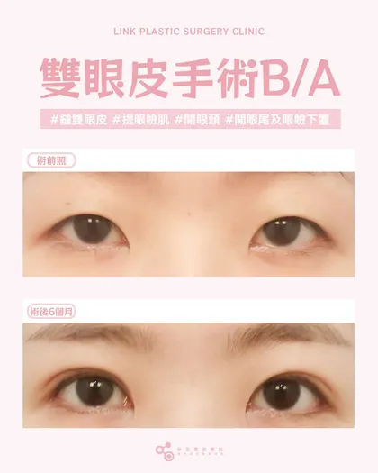 林克整形醫院 | 雙眼皮術後真實案例分享 ✨💙手術項目: 縫雙眼皮💙讓眼神更有層次感的選擇縫雙眼皮，