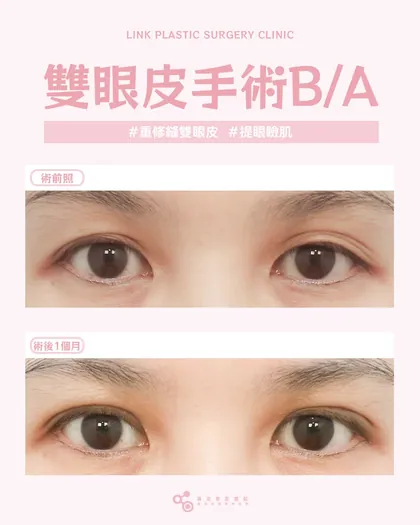 林克整形醫院 | 雙眼皮術後真實案例分享 ✨🧡手術項目: 重修縫雙眼皮+提眼瞼肌🧡改善雙眼皮鬆脫、消