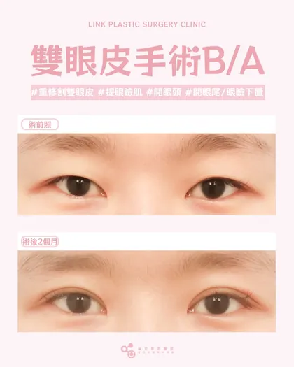林克整形醫院 | 雙眼皮術後真實案例分享 ✨🧡手術項目: 重修割雙眼皮+提眼瞼肌+開眼頭+眼尾及眼瞼