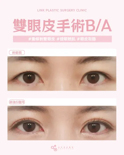 林克整形醫院 | 雙眼皮術後真實案例分享 ✨🧡手術項目: 重修割雙眼皮+提眼瞼肌+眼皮取脂🧡不再被不