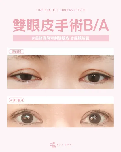 林克整形醫院 | 雙眼皮術後真實案例分享 ✨🧡手術項目: 高難度重修寬降窄割雙眼皮+提眼瞼肌🧡被修壞