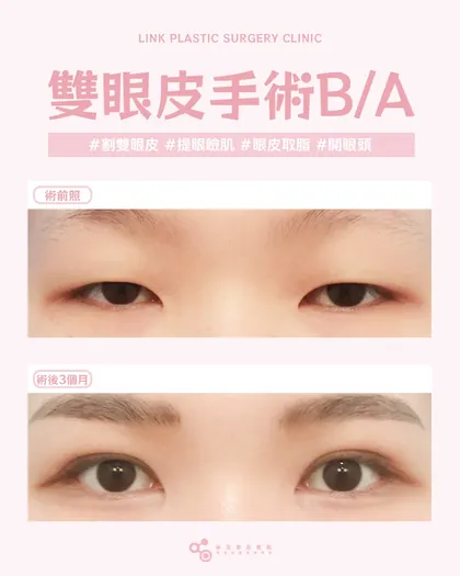 林克整形醫院 | 雙眼皮術後真實案例分享 ✨💜手術項目: 割雙眼皮+提眼瞼肌+眼皮取脂+開眼頭💜穩定