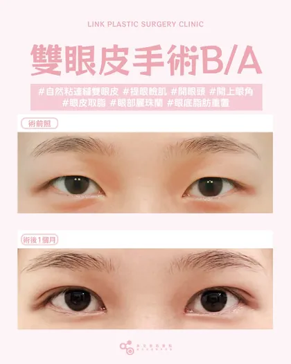 林克整形醫院 | 雙眼皮術後真實案例分享 ✨💙手術項目: 縫雙眼皮+提眼瞼肌+開眼頭+眼皮取脂+眼底