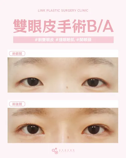 林克整形醫院 | 雙眼皮術後真實案例分享 ✨💜手術項目: 割雙眼皮+提眼瞼肌+開眼頭💜量身打造的眼型