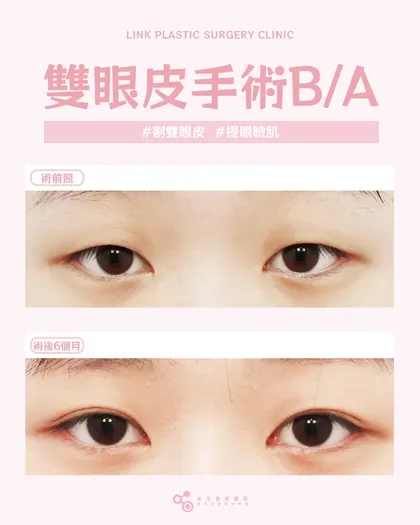 林克整形醫院 | 雙眼皮術後真實案例分享 ✨💜手術項目: 割雙眼皮+提眼瞼肌💜一步到位的雙眼皮改善割