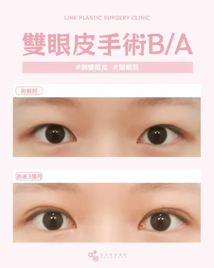 林克整形醫院 | 雙眼皮術後真實案例分享 ✨💜手術項目: 割雙眼皮+開眼頭💜量身打造的眼型設計割雙眼