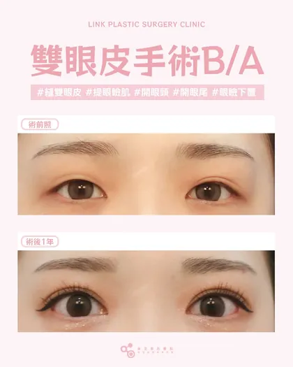 林克整形醫院 | 雙眼皮術後真實案例分享 ✨💙手術項目: 縫雙眼皮+提眼瞼肌+開眼頭+開眼尾+眼瞼下