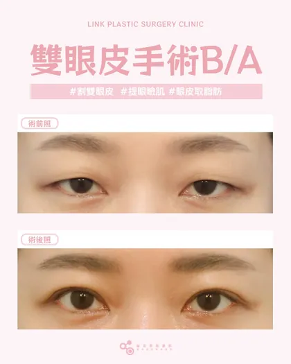 林克整形醫院 | 雙眼皮術後真實案例分享 ✨💜手術項目: 割雙眼皮+提眼瞼肌+眼皮取脂💜自然感割雙眼