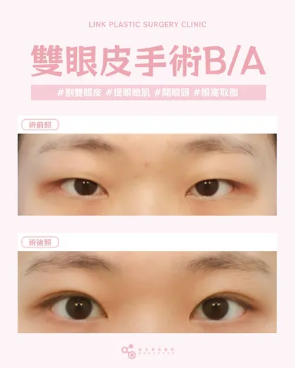 林克整形醫院 | 雙眼皮術後真實案例分享 ✨💜手術項目: 割雙眼皮+提眼瞼肌+開眼頭+眼皮取脂💜你以
