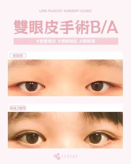 林克整形醫院 | 雙眼皮術後真實案例分享 ✨💜手術項目: 割雙眼皮+提眼瞼肌+開眼頭💜自然美的秘密就