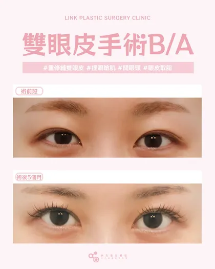 林克整形醫院 | 雙眼皮術後真實案例分享 ✨🧡手術項目: 重修縫雙眼皮+提眼瞼肌+開眼頭+眼皮取脂🧡