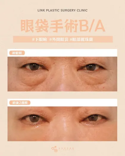 林克整形醫院 | 眼袋術後真實案例分享 ✨🩷手術項目: 下眼瞼手術(外開眼袋)+眼部麗珠蘭🩷外開眼袋
