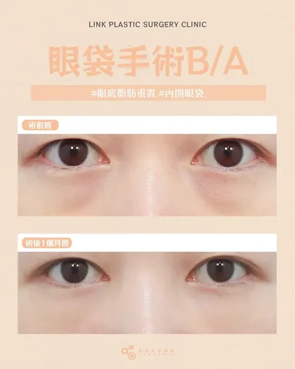 林克整形醫院 | 眼袋術後真實案例分享 ✨🩷手術項目: 眼底脂肪重置🩷眼下平了，氣色就對了眼袋手術的
