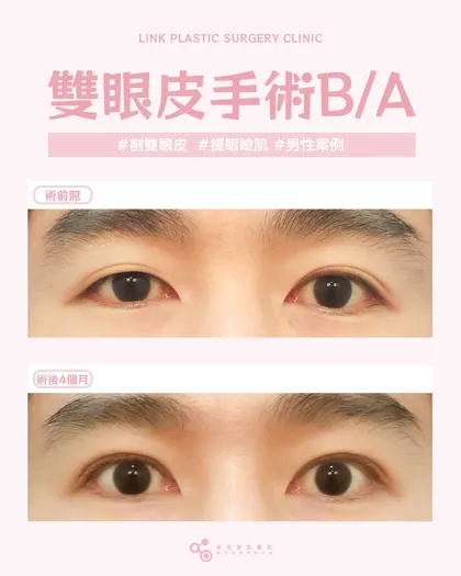 林克整形醫院 | 雙眼皮術後真實案例分享 ✨🤎手術項目: 割雙眼皮+提眼瞼肌🤎乾淨利落的型男眼神雙眼