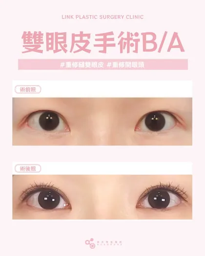 林克整形醫院 | 雙眼皮術後真實案例分享 ✨🧡手術項目: 重修自然粘連縫雙眼皮+眼頭重修🧡人生中最後