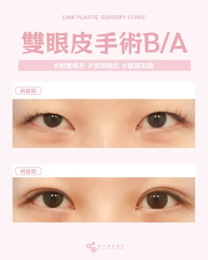 林克整形醫院 | 雙眼皮術後真實案例分享 ✨💜手術項目: 割雙眼皮+提眼瞼肌+眼皮取脂💜自然感割雙眼
