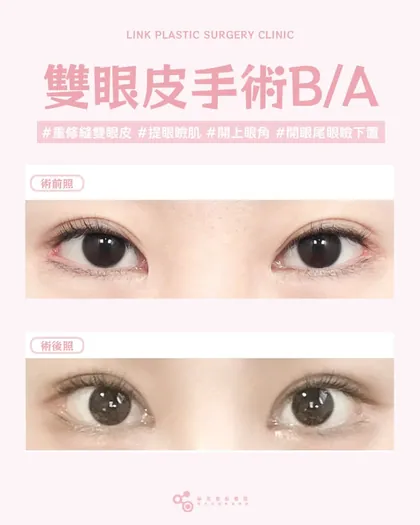 林克整形醫院 | 雙眼皮術後真實案例分享 ✨🧡手術項目: 重修自然粘連縫雙眼皮+提眼瞼肌+開上眼角+