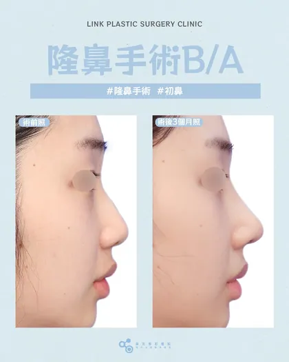 林克整形醫院 | 隆鼻術後真實案例分享 ✨🩵手術項目: 隆鼻初次手術🩵告別塌鼻困擾｜你也能擁有精緻側