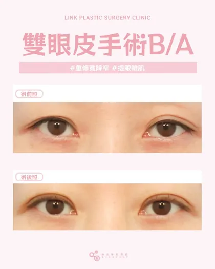林克整形醫院 | 雙眼皮術後真實案例分享 ✨🧡手術項目: 重修寬降窄割雙眼皮+提眼瞼肌🧡每一次重修，
