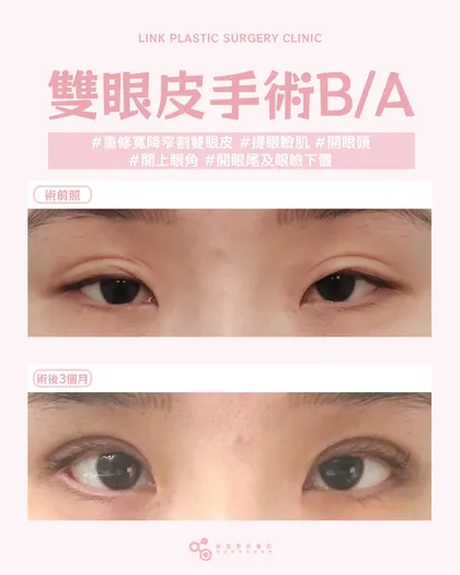 林克整形醫院 | 雙眼皮術後真實案例分享 ✨🧡手術項目: 高難度重修寬降窄割雙眼皮+提眼瞼肌+開頭眼