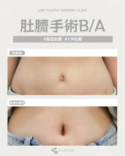 林克整形醫院 | 肚臍術後真實案例分享 ✨🤍手術項目: 肚臍手術🤍告別凸肚臍、外翻、過大形狀打造你真