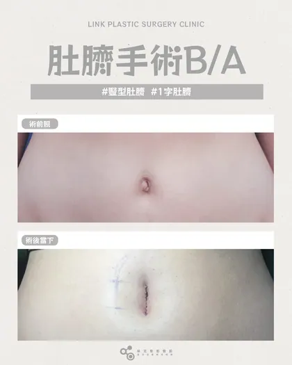 林克整形醫院 | 肚臍術後真實案例分享 ✨🤍手術項目: 肚臍手術🤍不滿意肚臍形狀嗎?腹部的細節，決定