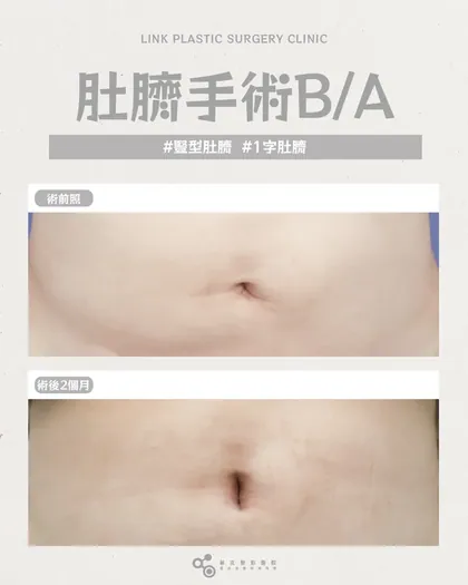 林克整形醫院 | 肚臍術後真實案例分享 ✨🤍手術項目: 肚臍手術🤍從變形到自然｜重新打造乾淨的小肚臍