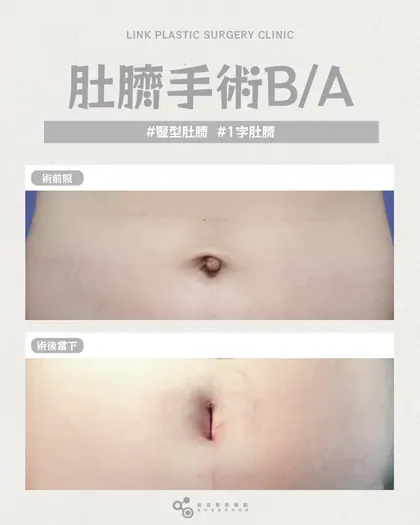 林克整形醫院 | 肚臍術後真實案例分享 ✨🤍手術項目: 肚臍手術🤍肚臍變形修復術｜自然＝最好的效果不