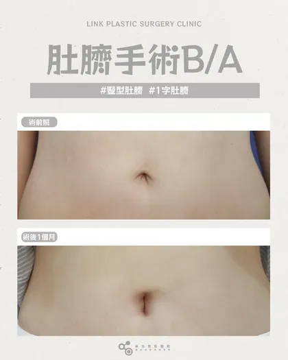 林克整形醫院 | 肚臍術後真實案例分享 ✨🤍手術項目: 肚臍手術🤍肚臍變形不用遮，修復後自然又緊緻腹