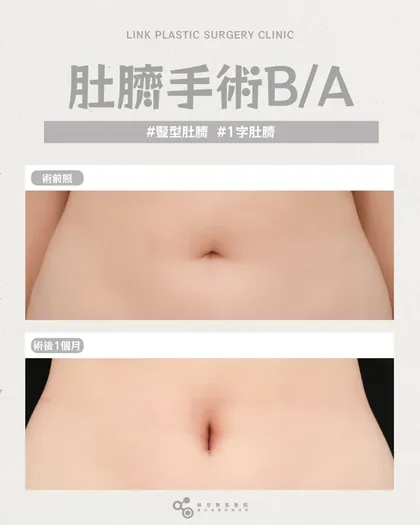 林克整形醫院 | 肚臍術後真實案例分享 ✨🤍手術項目: 肚臍手術🤍變形肚臍改善｜改善鬆垮、對稱度、深