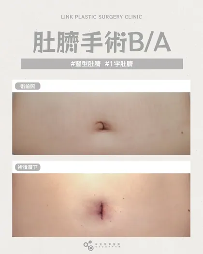 林克整形醫院 | 肚臍術後真實案例分享 ✨🤍手術項目: 肚臍手術🤍手術前：變形｜手術後：自然不是換一