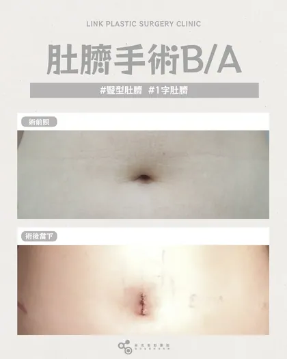 林克整形醫院 | 肚臍術後真實案例分享 ✨🤍手術項目: 肚臍手術🤍同一個腹部，不一樣的完成度手術前後