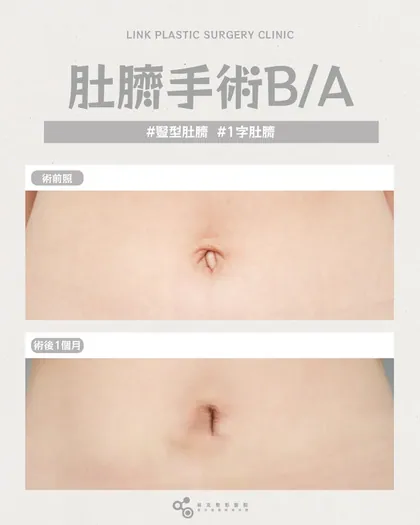 林克整形醫院 | 肚臍術後真實案例分享 ✨🤍手術項目: 肚臍手術🤍變形肚臍修復｜找回自然內凹感讓肚臍