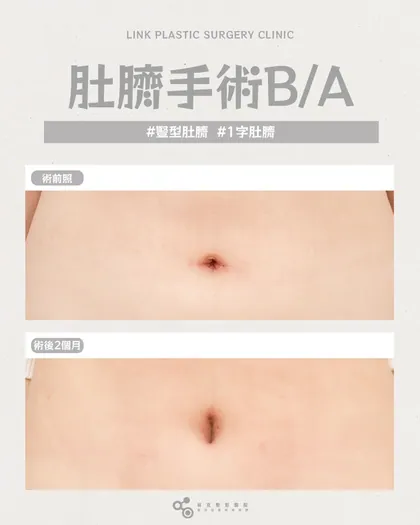林克整形醫院 | 肚臍術後真實案例分享 ✨🤍手術項目: 肚臍手術🤍肚臍修好了，很多困擾就不見了穿衣、