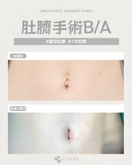 你不喜歡的肚臍形狀，是可以被改變的透過專業評估，讓它回到最適合你的樣子✨ 林克整形醫院 | 肚臍術後