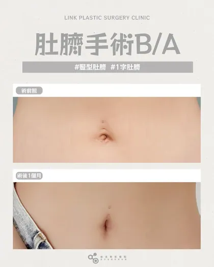 林克整形醫院 | 肚臍術後真實案例分享 ✨🤍手術項目: 肚臍手術🤍肚臍不是小細節，是腹部焦點變形改善
