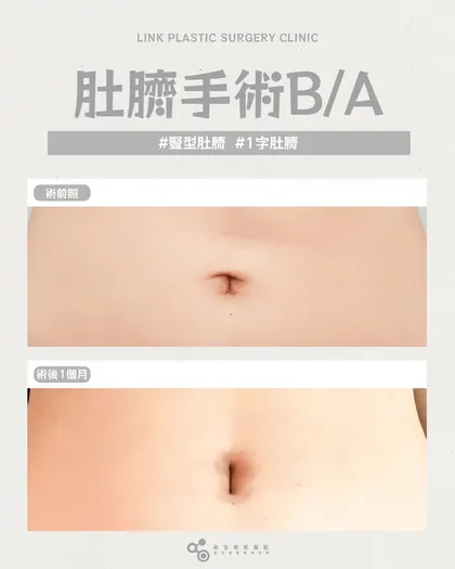 林克整形醫院 | 肚臍術後真實案例分享 ✨🤍手術項目: 肚臍手術🤍變形肚臍也能重新設計依照腹部線條，