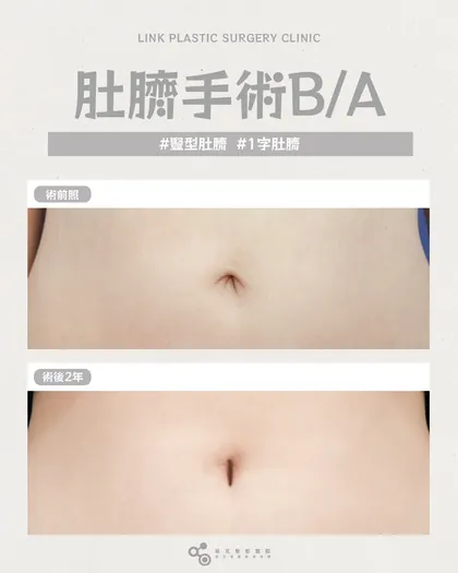 林克整形醫院 | 肚臍術後真實案例分享 ✨🤍手術項目: 肚臍手術🤍不需要誇張，只需要剛剛好肚臍整形的